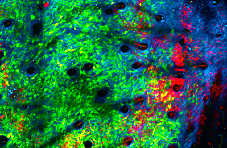 Cancer cells (green) being attacked by neutrophils (red) in collagen structutre